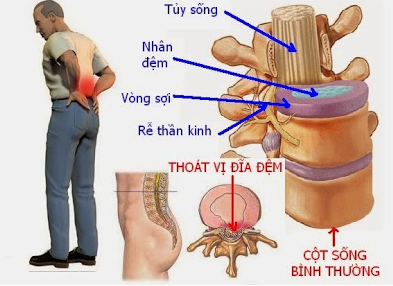 Nguyen-nhan-mac-benh-thoat-vi-dia-dem