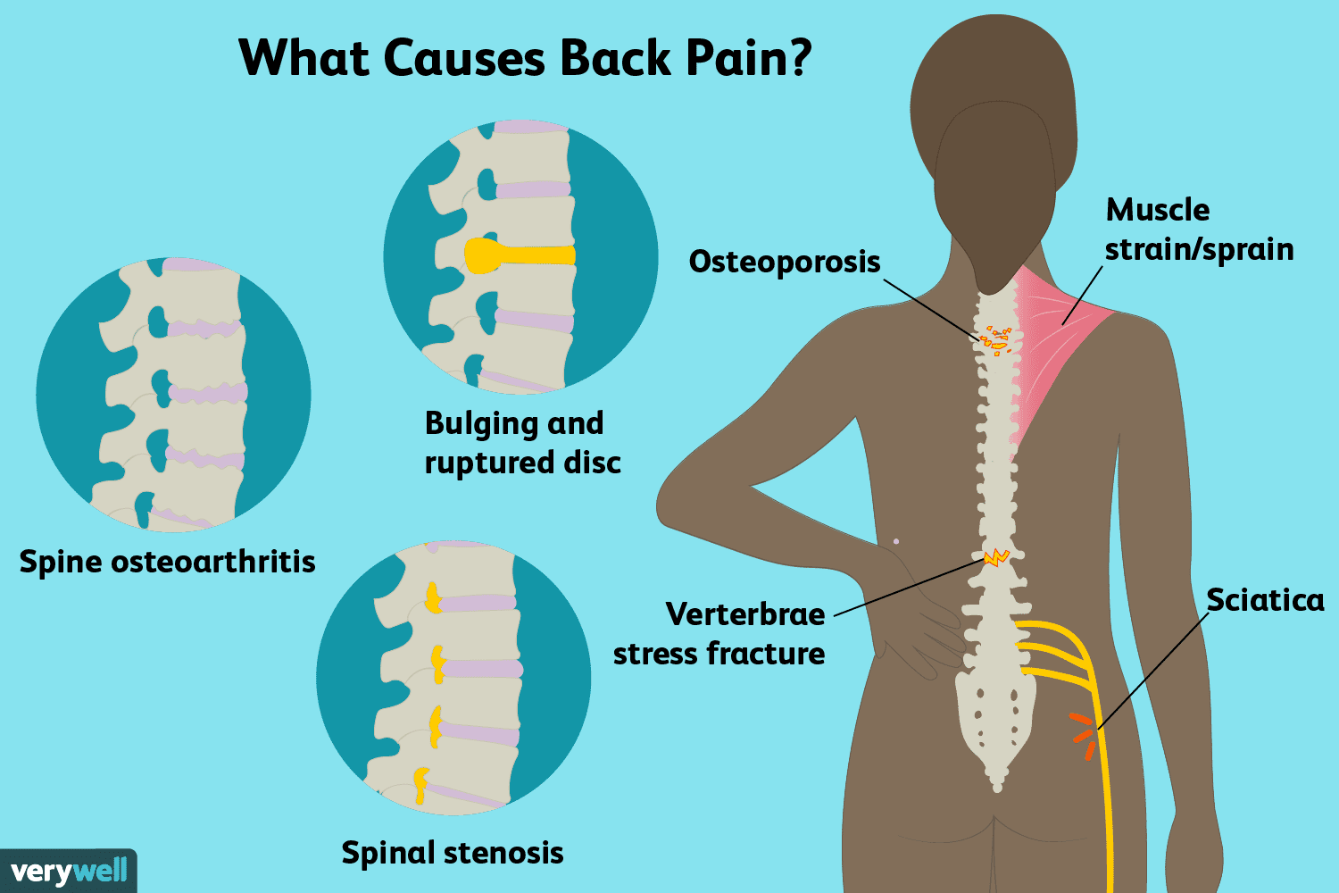 Nguyên nhân gây đau lưng không cúi xuống được
