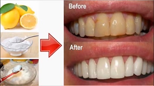Bạn đã biết cách làm trắng răng ố vàng tại nhà?