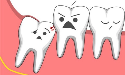Giải đáp thắc mắc liên quan tới răng khôn mọc ngầm?