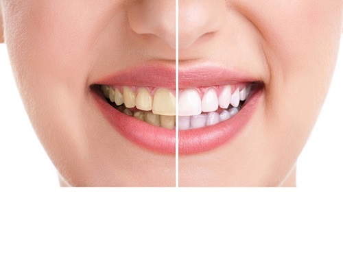 Bạn đã biết cách làm trắng răng bị ố vàng tại nhà?
