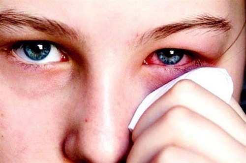 Cách chữa đau mắt đỏ bằng lá trầu không?